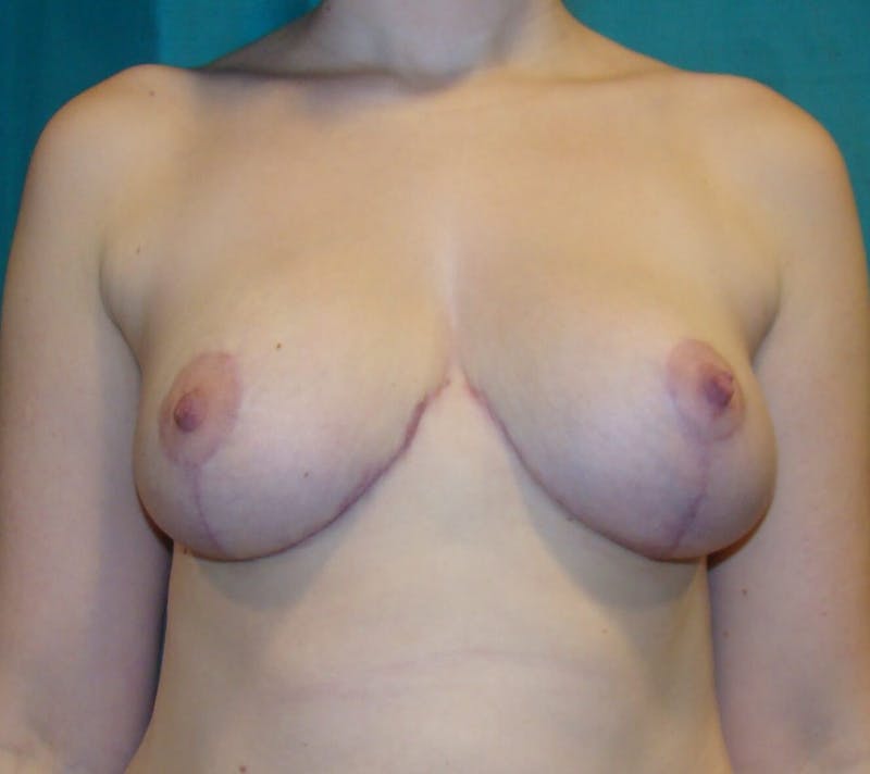 Breast Reduction Before & After Gallery - Patient 91459017 - Image 2
