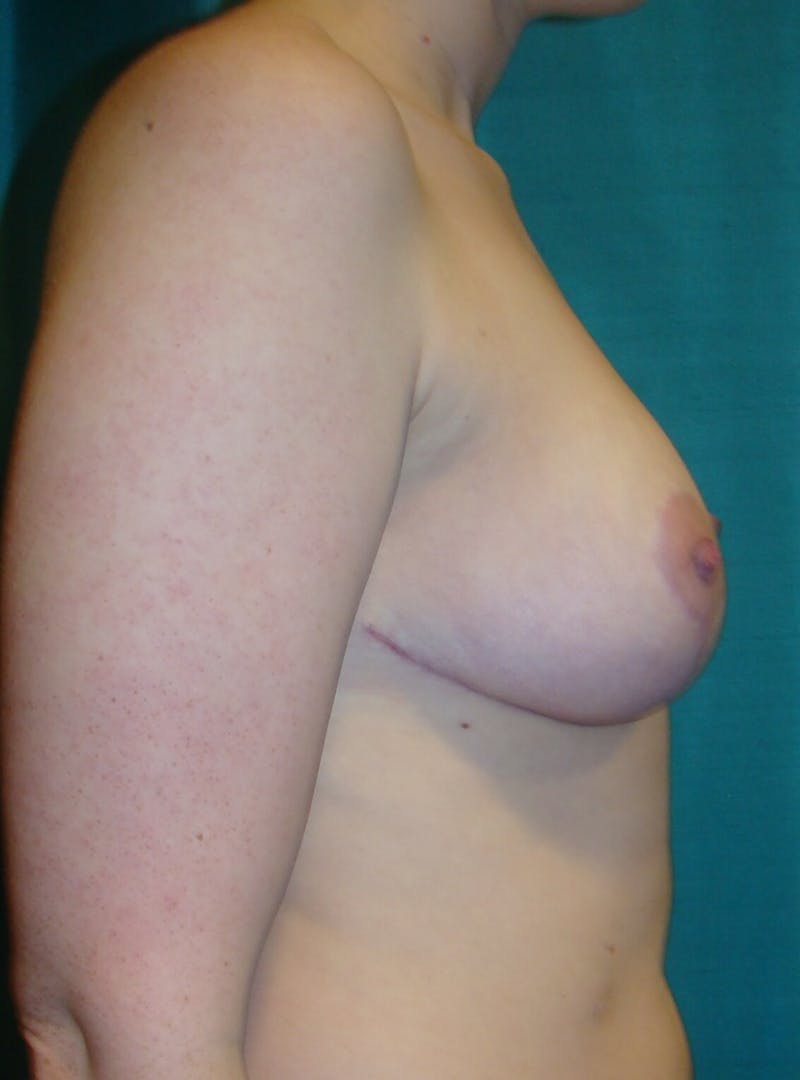 Breast Reduction Before & After Gallery - Patient 91459017 - Image 6