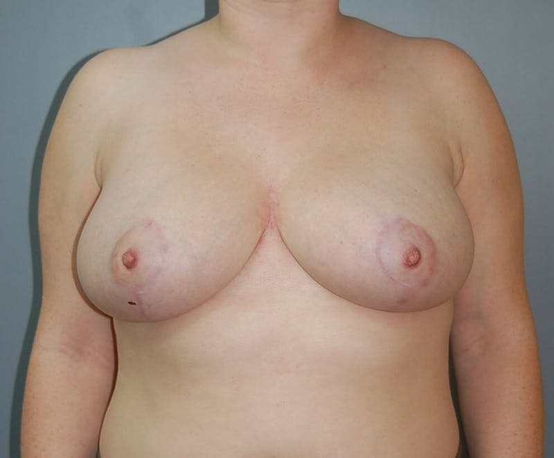 Breast Reduction Before & After Gallery - Patient 91459026 - Image 2
