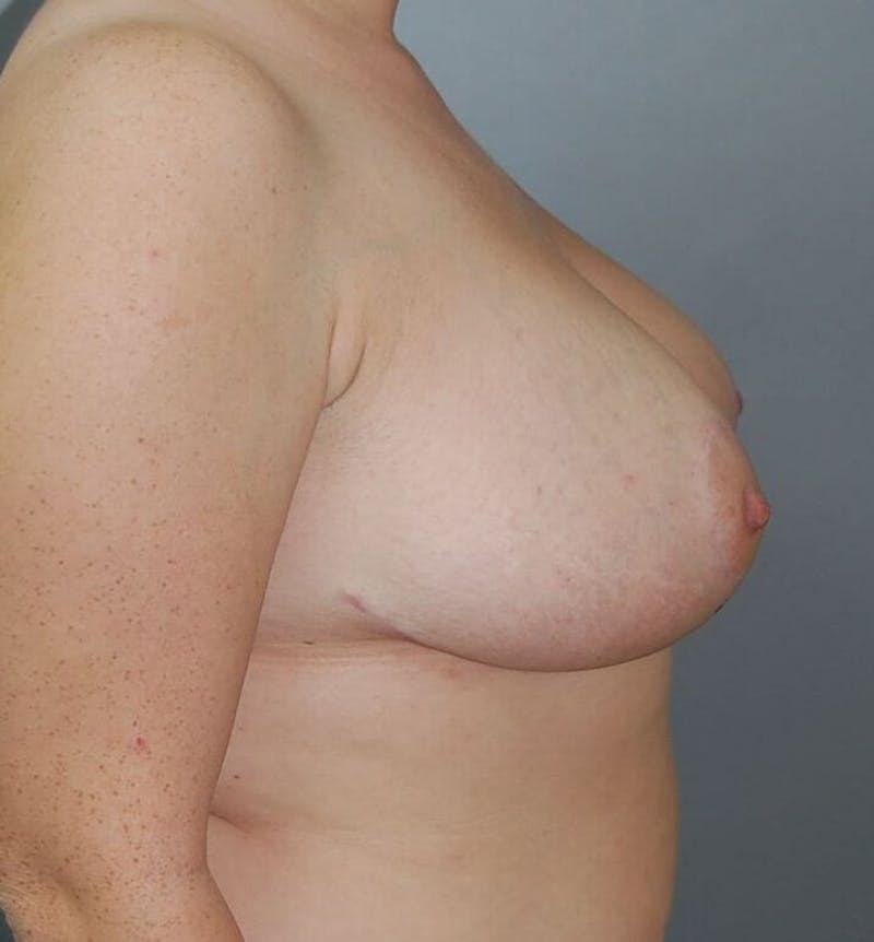 Breast Reduction Before & After Gallery - Patient 91459026 - Image 4