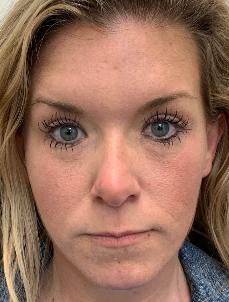 Kimberly Saffman, APRN Before & After Gallery - Patient 91459027 - Image 6