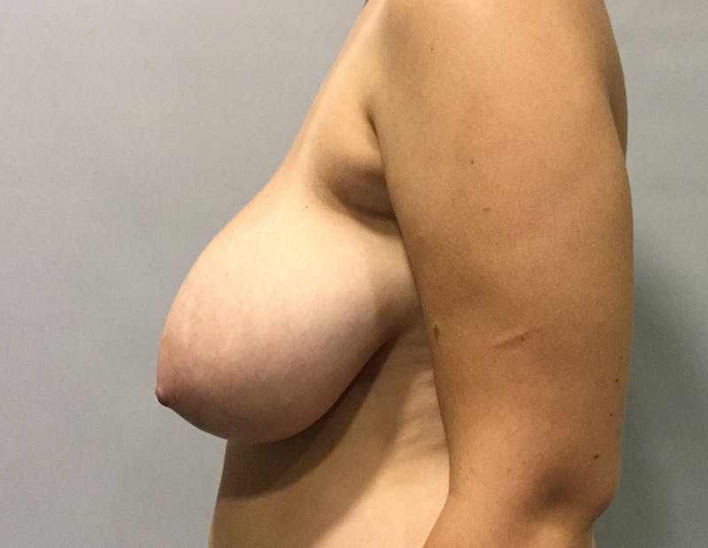 Breast Reduction Before & After Gallery - Patient 91459029 - Image 3