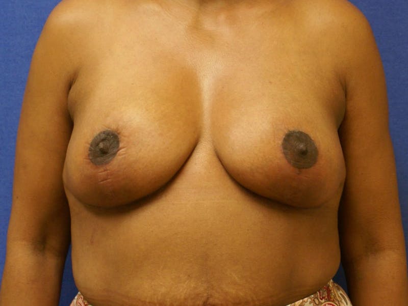 Breast Reduction Before & After Gallery - Patient 91459036 - Image 2