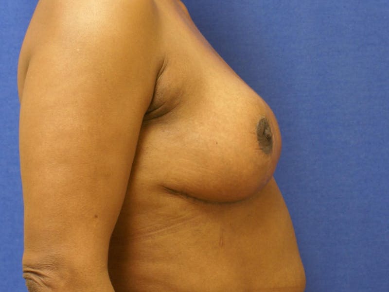 Breast Reduction Before & After Gallery - Patient 91459036 - Image 4