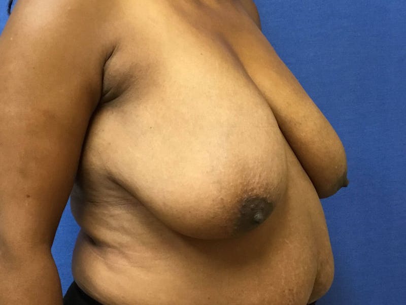 Breast Reduction Before & After Gallery - Patient 91459036 - Image 5