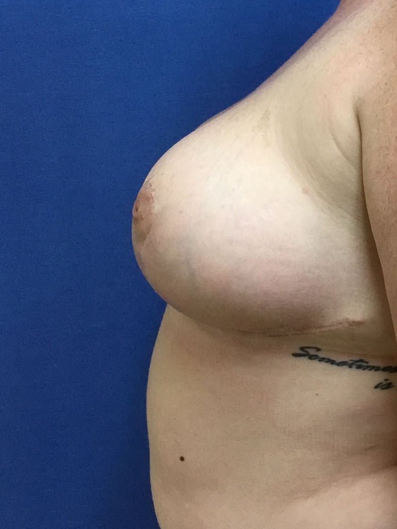 Breast Reduction Before & After Gallery - Patient 91459042 - Image 6