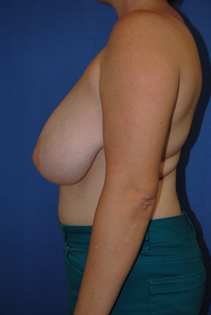 Breast Reduction Before & After Gallery - Patient 91459051 - Image 5