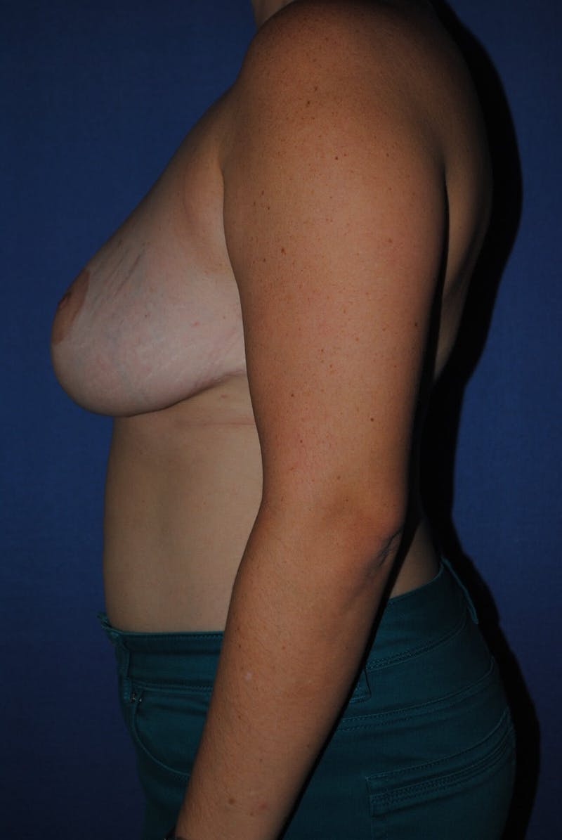 Breast Reduction Before & After Gallery - Patient 91459051 - Image 6