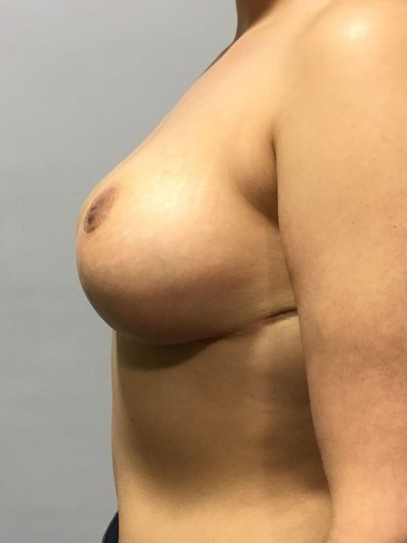 Breast Reduction Before & After Gallery - Patient 91459064 - Image 4
