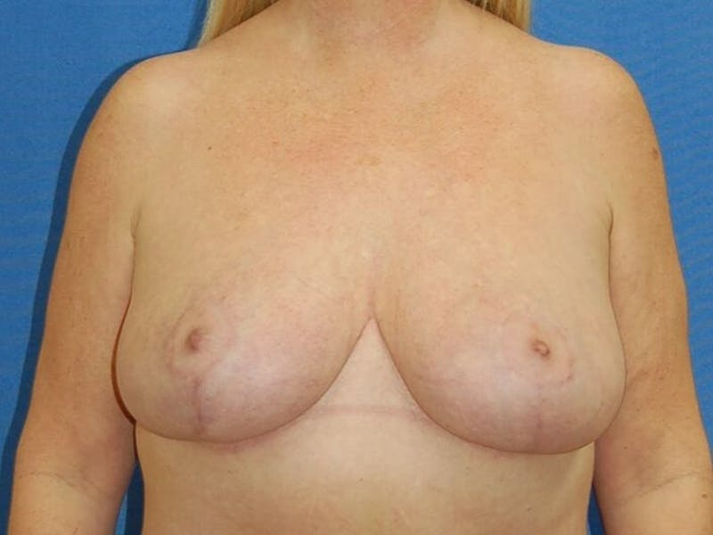 Breast Reduction Before & After Gallery - Patient 91459067 - Image 2