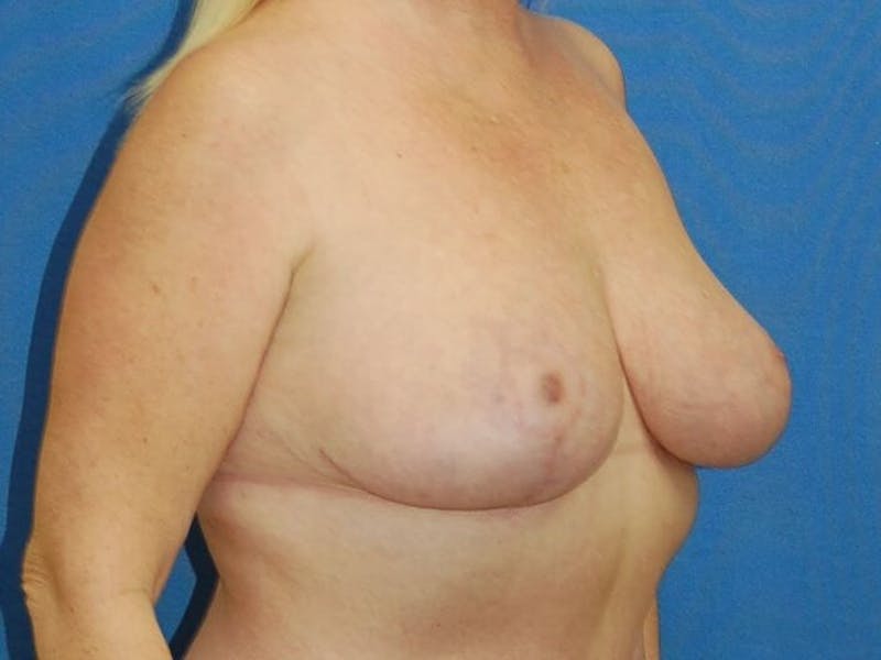 Breast Reduction Before & After Gallery - Patient 91459067 - Image 6