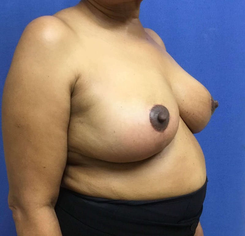 Breast Reduction Before & After Gallery - Patient 91459079 - Image 4