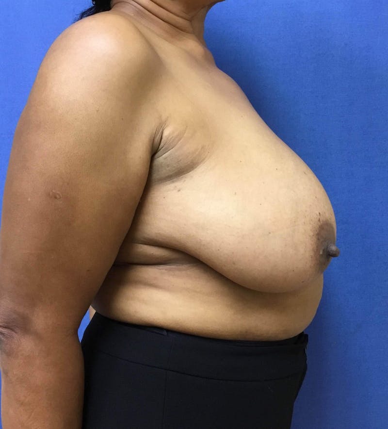 Breast Reduction Before & After Gallery - Patient 91459079 - Image 5