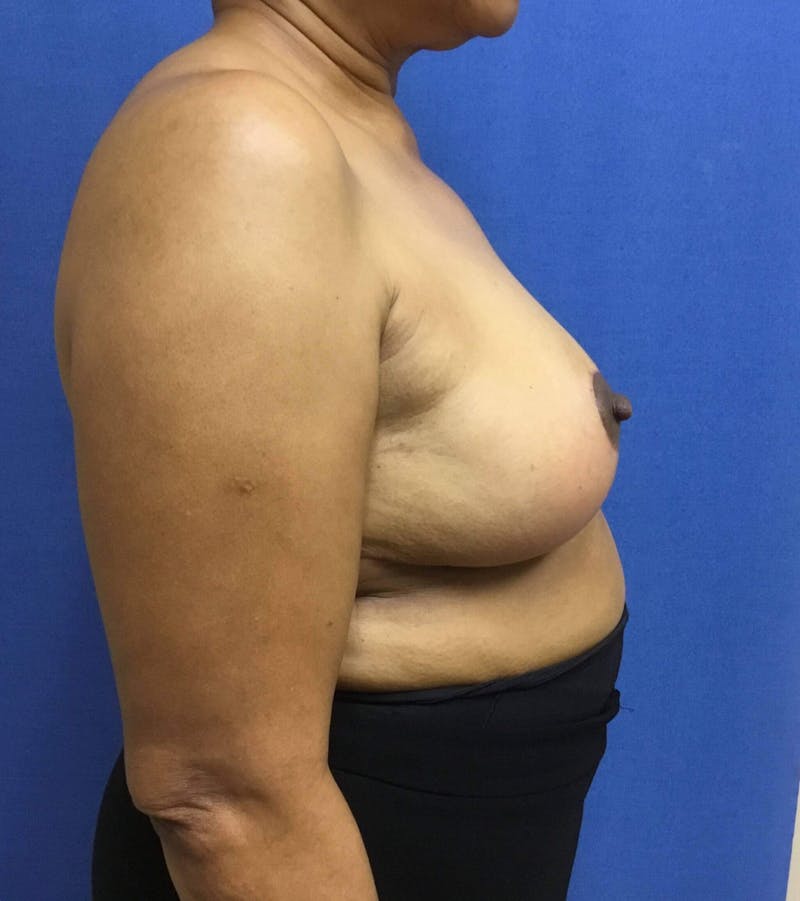 Breast Reduction Before & After Gallery - Patient 91459079 - Image 6