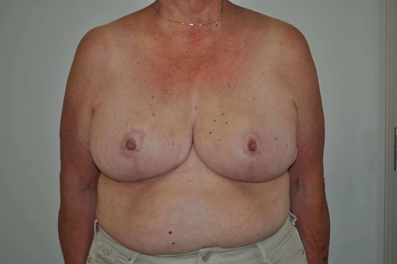 Breast Reduction Before & After Gallery - Patient 91459080 - Image 2