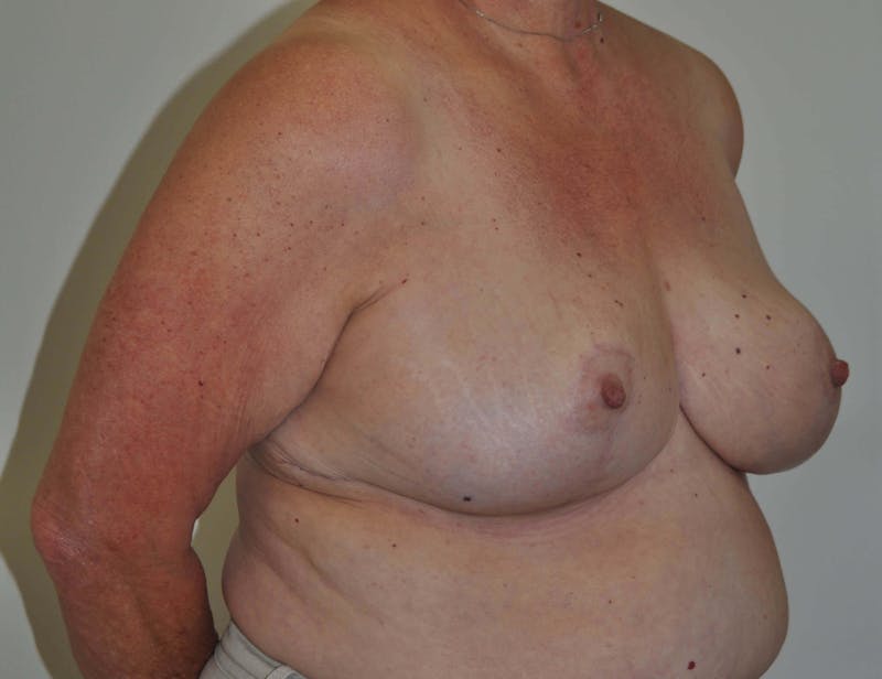 Breast Reduction Gallery - Patient 91459080 - Image 4