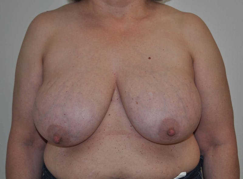 Breast Reduction Before & After Gallery - Patient 91459086 - Image 1