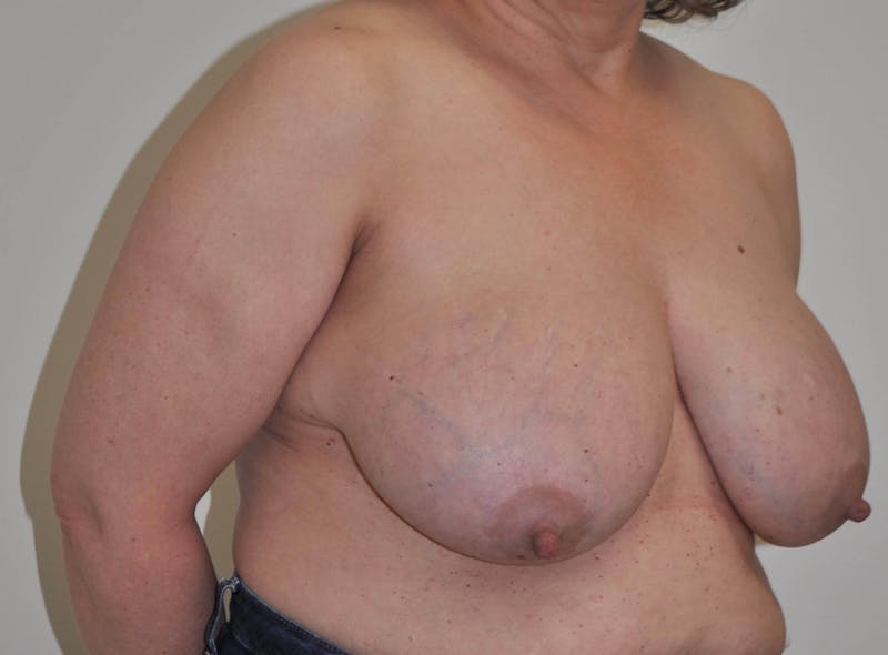 Breast Reduction Before & After Gallery - Patient 91459086 - Image 3