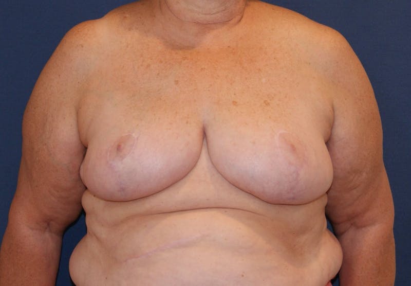 Breast Reduction Before & After Gallery - Patient 91459087 - Image 2