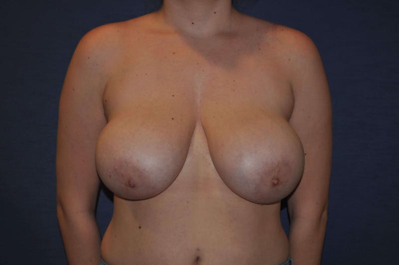 Breast Reduction Before & After Gallery - Patient 91459108 - Image 1