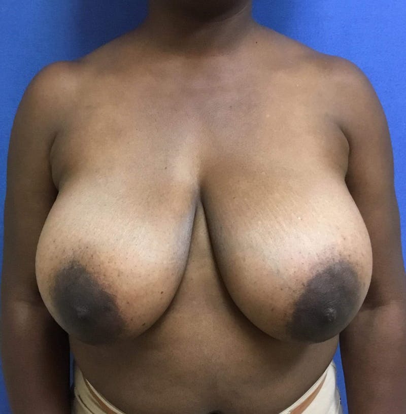 Breast Reduction Before & After Gallery - Patient 91459112 - Image 1