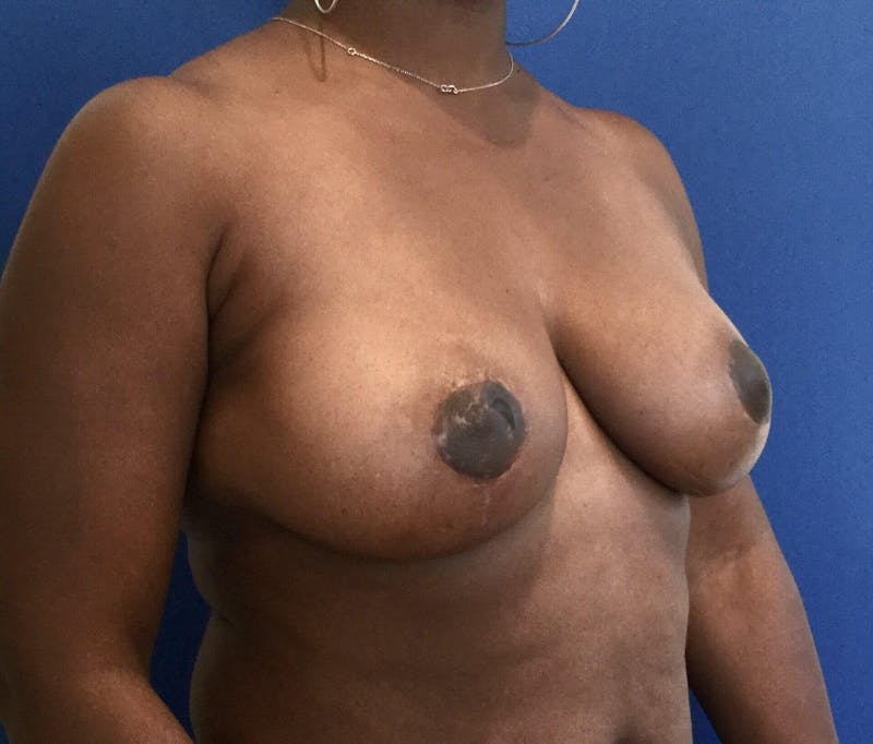 Breast Reduction Before & After Gallery - Patient 91459112 - Image 4