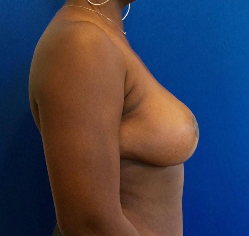 Breast Reduction Before & After Gallery - Patient 91459112 - Image 6