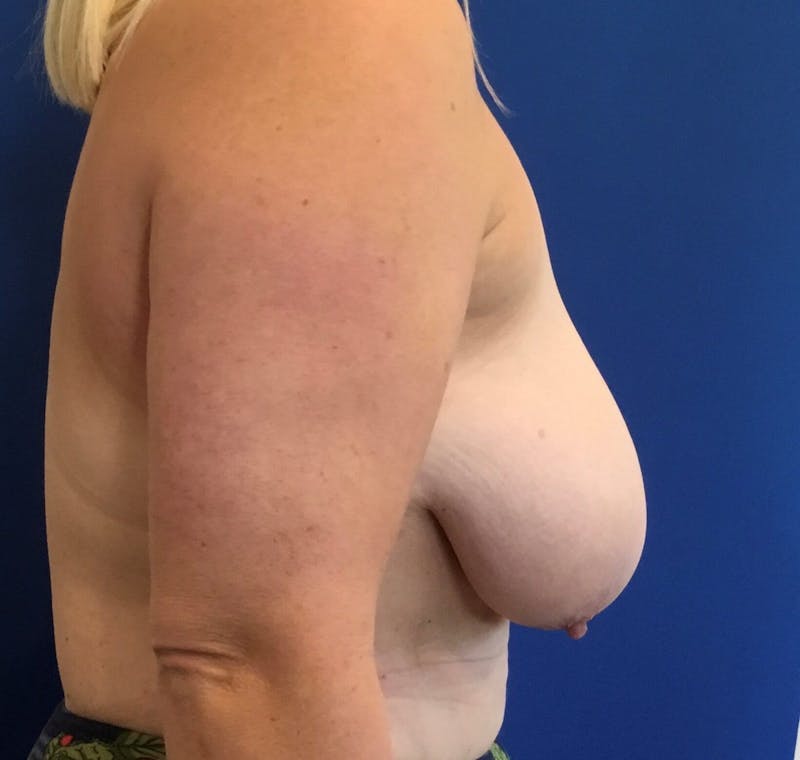 Breast Reduction Before & After Gallery - Patient 91459113 - Image 3