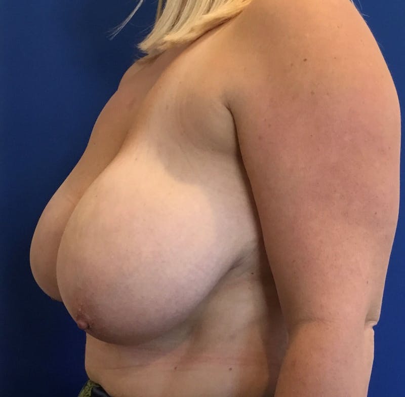 Breast Reduction Before & After Gallery - Patient 91459113 - Image 5