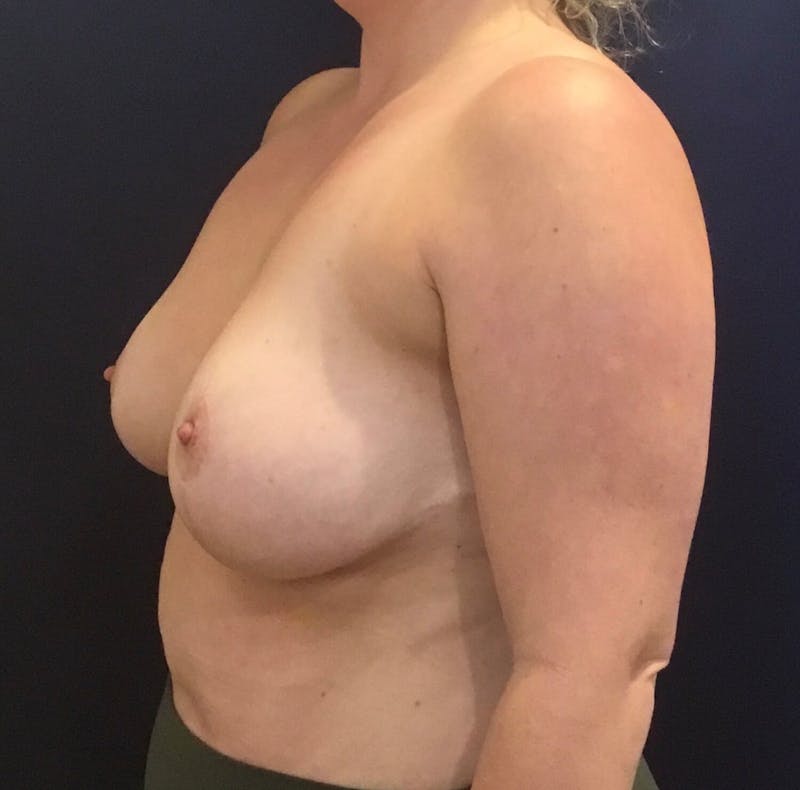 Breast Reduction Before & After Gallery - Patient 91459113 - Image 6