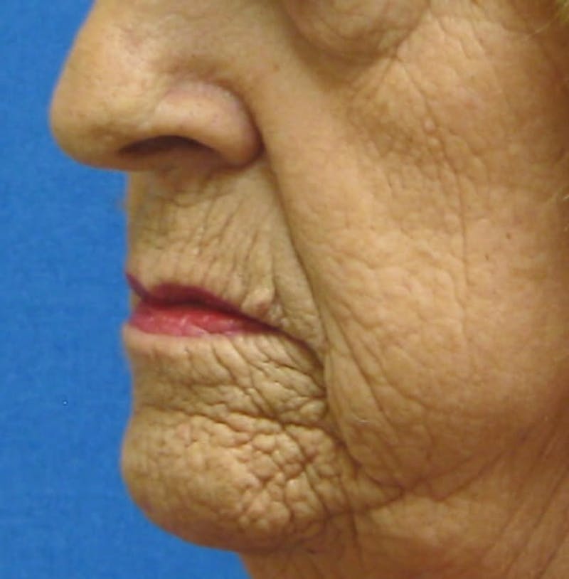 Laser Skin Resurfacing Before & After Gallery - Patient 91459193 - Image 3