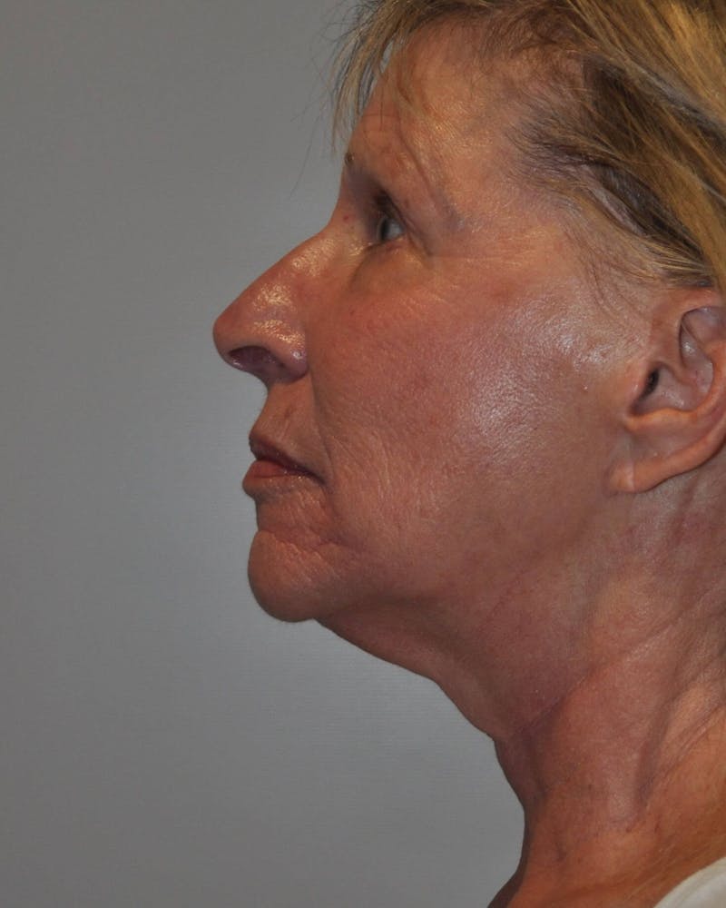 Laser Skin Resurfacing Before & After Gallery - Patient 91459200 - Image 3