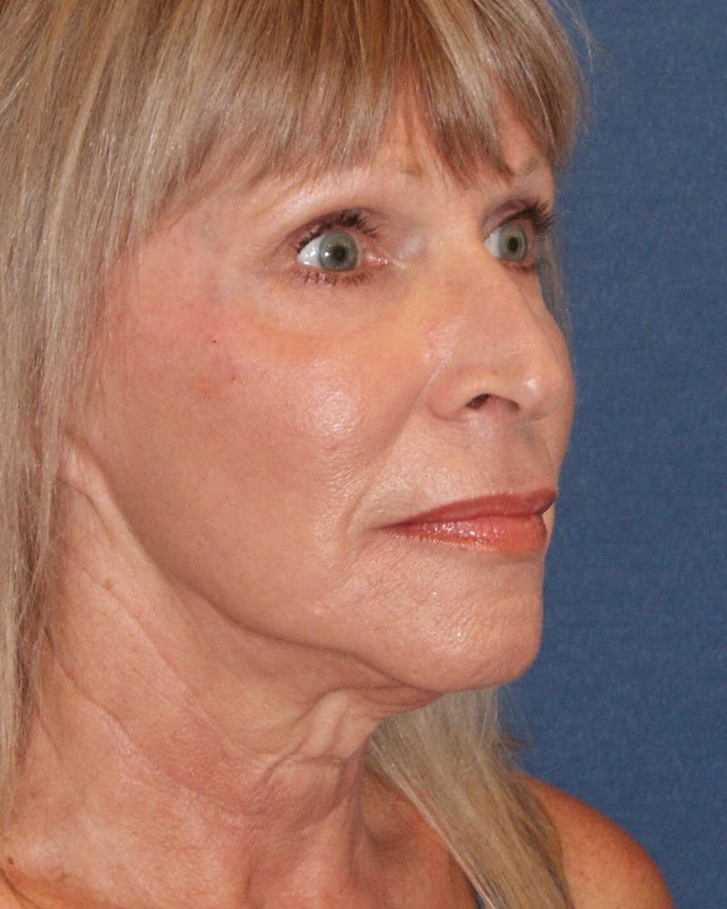 Laser Skin Resurfacing Before & After Gallery - Patient 91459200 - Image 6