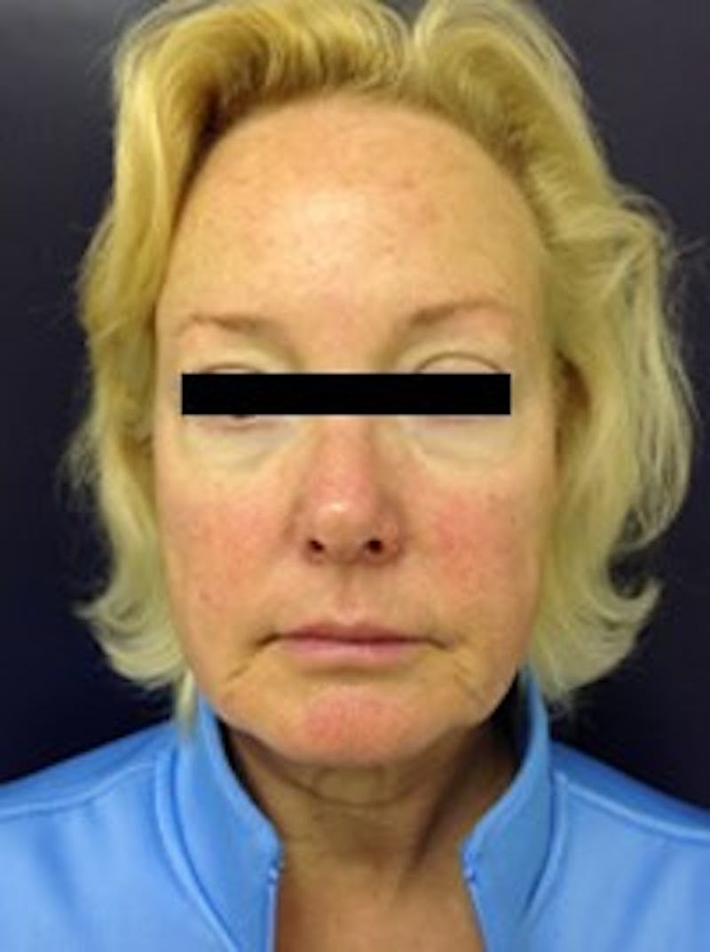 Laser Skin Resurfacing Before & After Gallery - Patient 91459202 - Image 1