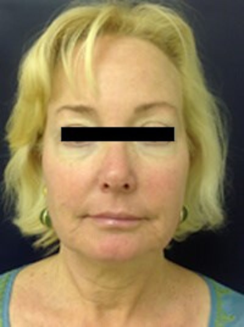 Laser Skin Resurfacing Before & After Gallery - Patient 91459202 - Image 2