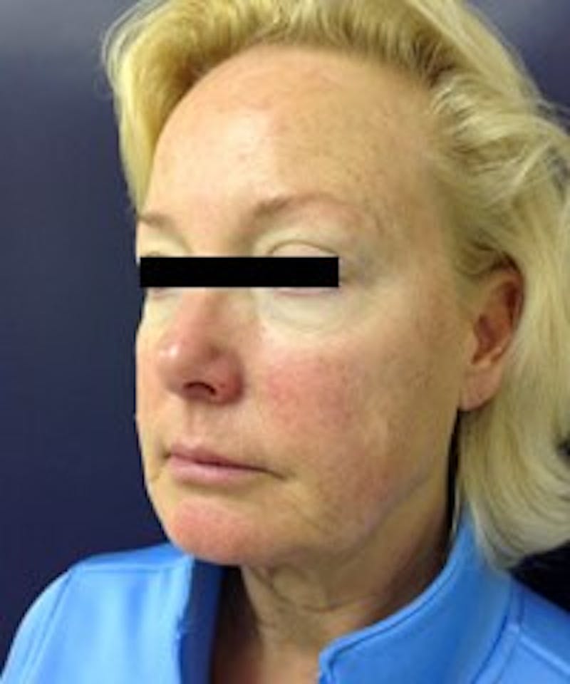 Laser Skin Resurfacing Before & After Gallery - Patient 91459202 - Image 5