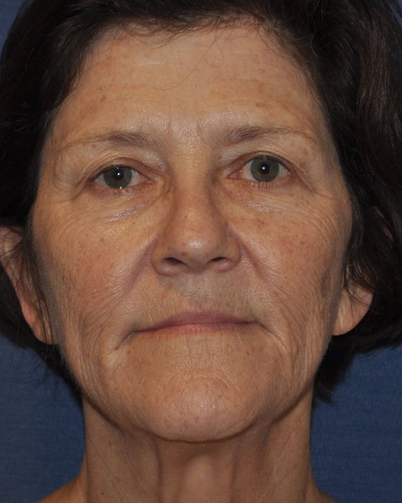 Laser Skin Resurfacing Before & After Gallery - Patient 91459213 - Image 1