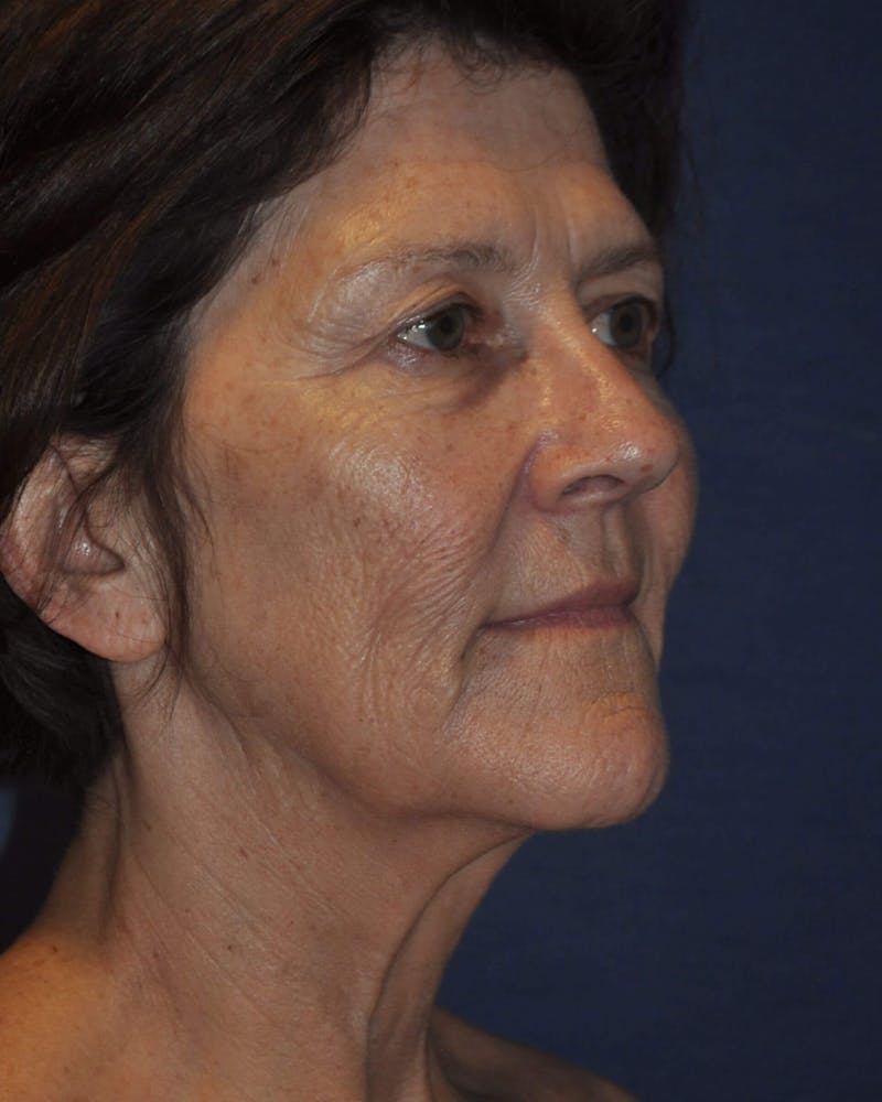 Laser Skin Resurfacing Before & After Gallery - Patient 91459213 - Image 5
