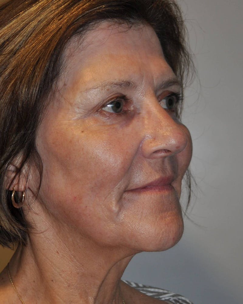 Laser Skin Resurfacing Before & After Gallery - Patient 91459213 - Image 6