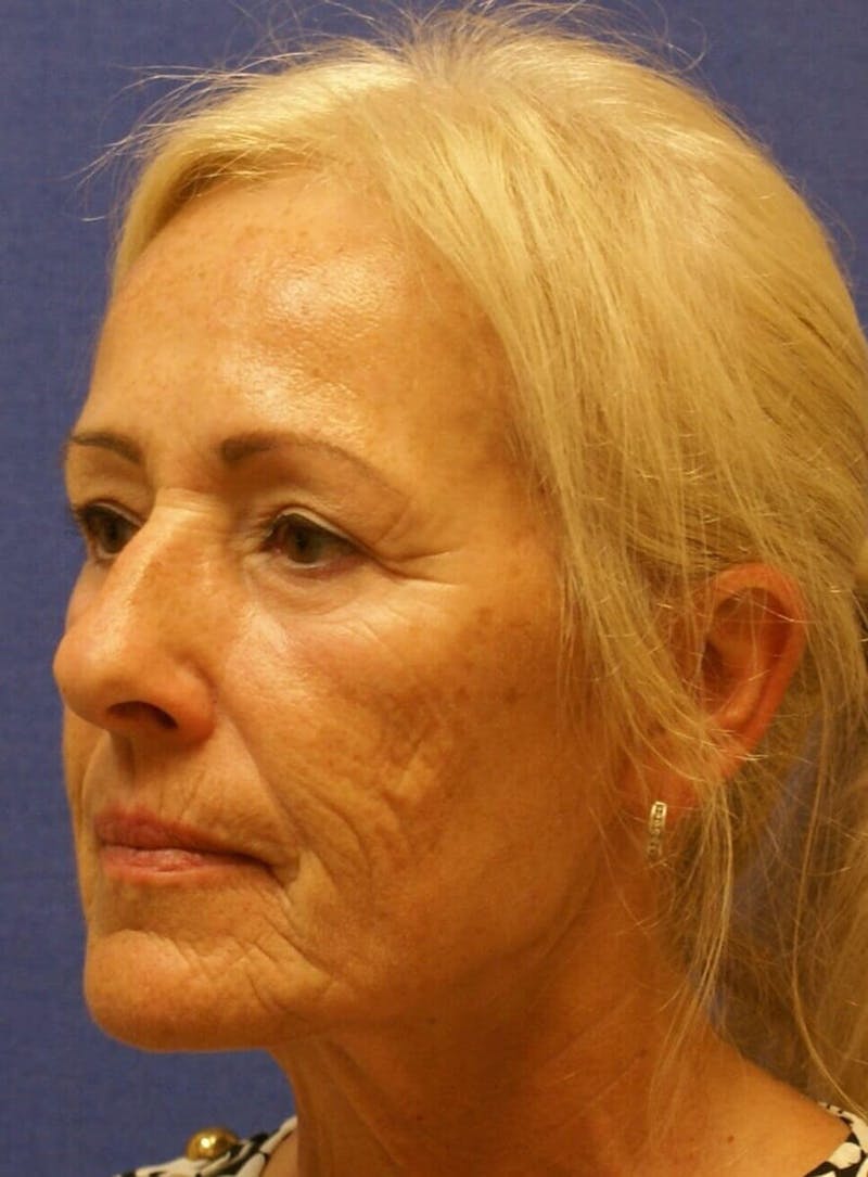 Laser Skin Resurfacing Before & After Gallery - Patient 91459221 - Image 3
