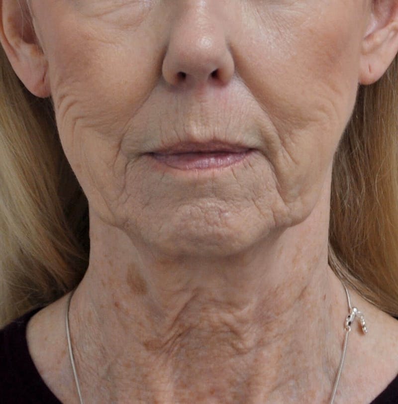 Laser Skin Resurfacing Before & After Gallery - Patient 91459226 - Image 1