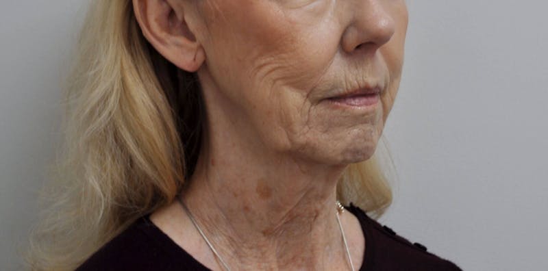 Laser Skin Resurfacing Before & After Gallery - Patient 91459226 - Image 3