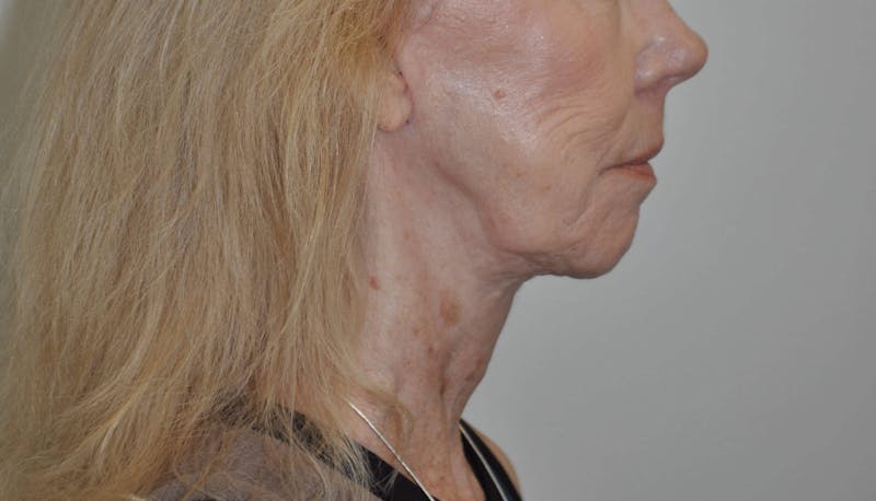 Laser Skin Resurfacing Before & After Gallery - Patient 91459226 - Image 6