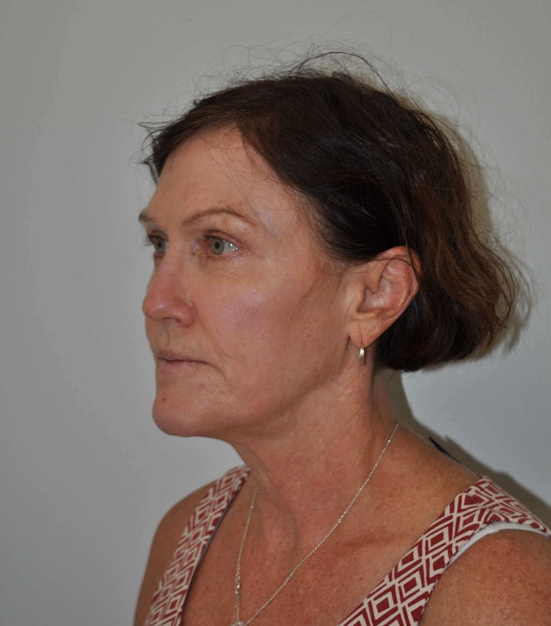 Laser Skin Resurfacing Before & After Gallery - Patient 91459229 - Image 4