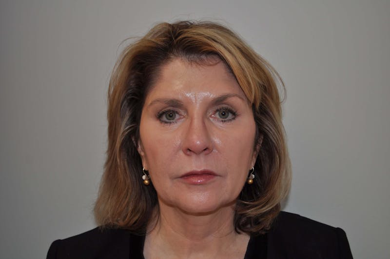Laser Skin Resurfacing Before & After Gallery - Patient 91459239 - Image 2