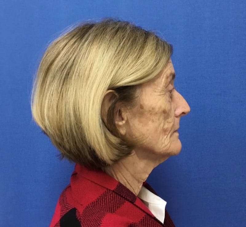 Laser Skin Resurfacing Before & After Gallery - Patient 91459247 - Image 5
