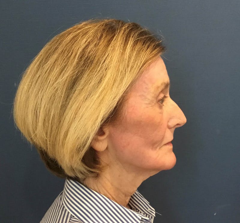 Laser Skin Resurfacing Before & After Gallery - Patient 91459247 - Image 6
