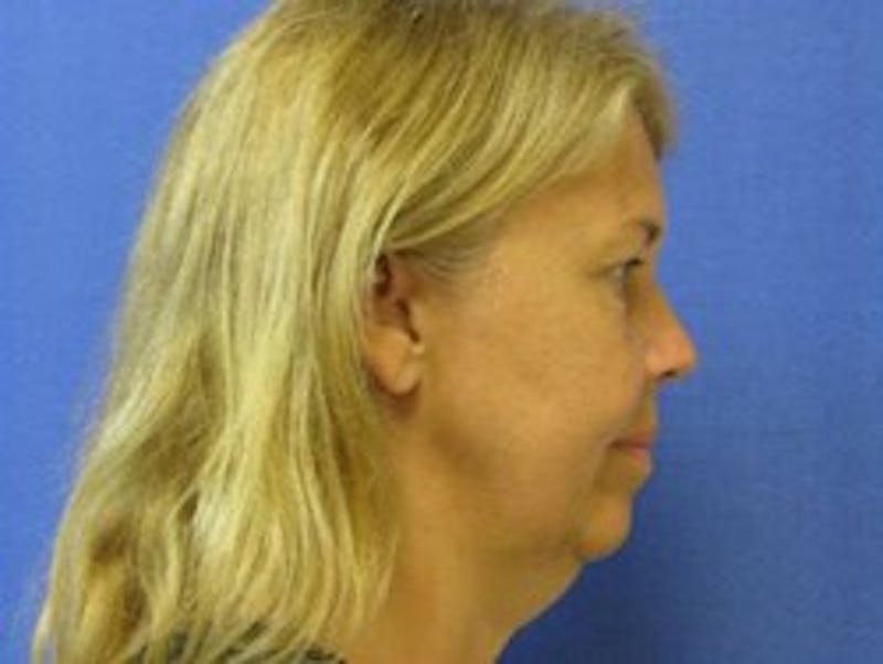 Neck Liposuction Before & After Gallery - Patient 91459373 - Image 1