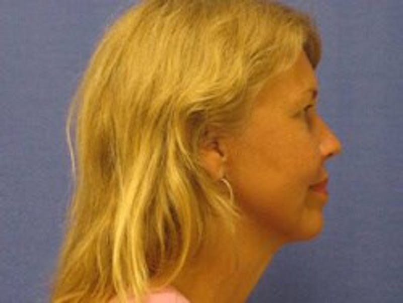 Neck Liposuction Before & After Gallery - Patient 91459373 - Image 2