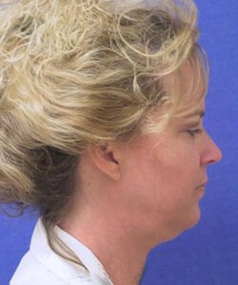 Neck Liposuction Before & After Gallery - Patient 91459375 - Image 1